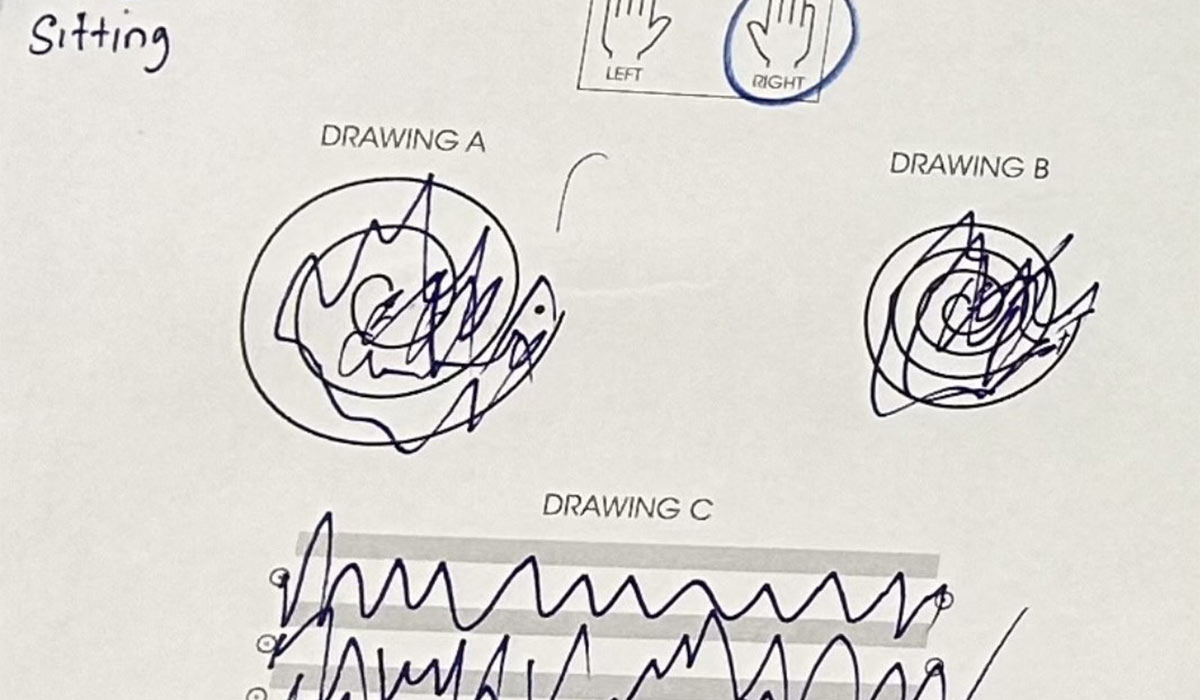 Before HIFU treatment
